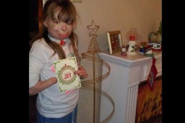 Παγκόσμια συγκίνηση για το 8χρονο ορφανό κοριτσάκι που παραμορφώθηκε σε φωτιά -Ζητάει Χριστουγεννιάτικες κάρτες