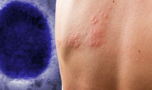 Ευλογιά των πιθήκων: Αυτοί δεν πρόκειται να κολλήσουν ποτέ γιατί είναι επαρκώς προστατευμένοι