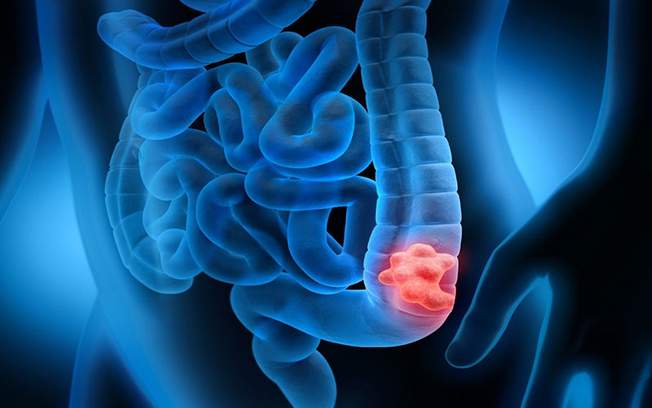 Self test για τον καρκίνο του παχέος εντέρου στα φαρμακεία - Δωρεάν με ένα SMS