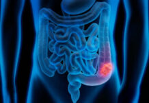 Ανοσοθεραπεία πριν από χειρουργείο: Νέες ελπίδες για τον καρκίνο του εντέρου