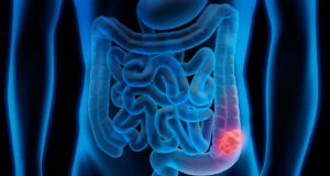 Ανοσοθεραπεία πριν από χειρουργείο: Νέες ελπίδες για τον καρκίνο του εντέρου