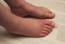 Πρησμένα Πόδια; 9 Φυσικές Λύσεις για Άμεση Ανακούφιση στο Σπίτι
