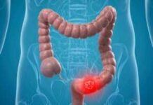 5 Φρούτα 'Κλειδιά' για την Πρόληψη του Καρκίνου Παχέος Εντέρου