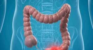 5 Φρούτα 'Κλειδιά' για την Πρόληψη του Καρκίνου Παχέος Εντέρου