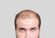 Φυσικός Ορός κατά της Τριχόπτωσης: Ελπίδα Βελτίωσης σε 8 Εβδομάδες