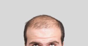 Φυσικός Ορός κατά της Τριχόπτωσης: Ελπίδα Βελτίωσης σε 8 Εβδομάδες