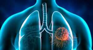 Καρκίνος Πνεύμονα: Νέα Έρευνα για τον Παράδοξο Κίνδυνο σε Μη Καπνιστές